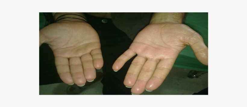 Difference Between Left Sympathectomised And Right - Ring, transparent png #3540540