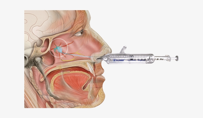Headache/migraine Program - Mirx Protocol - Nasal Applicator, transparent png #3542256