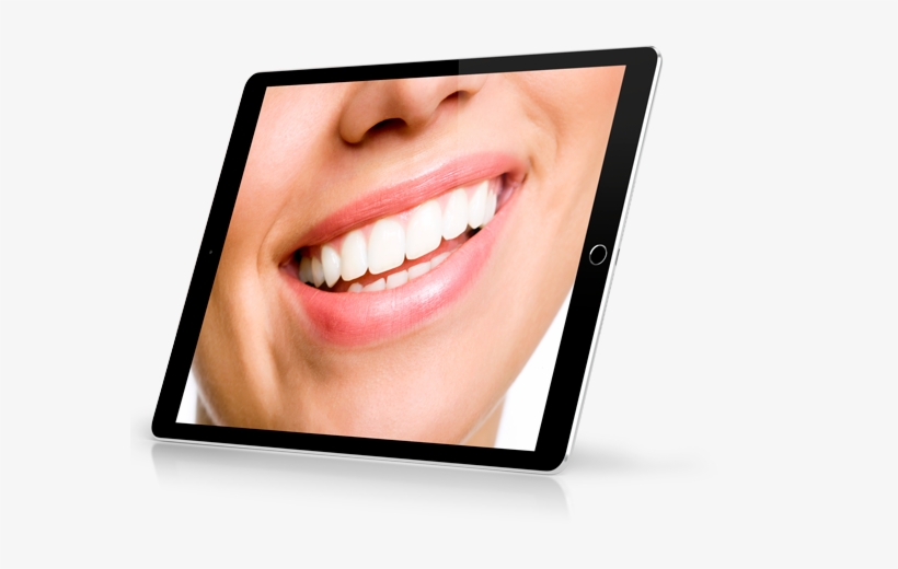 Dentatis Ipad Sonrisa - Everwhitetm Teeth Whitening Accelerator Light 5x More, transparent png #3546705