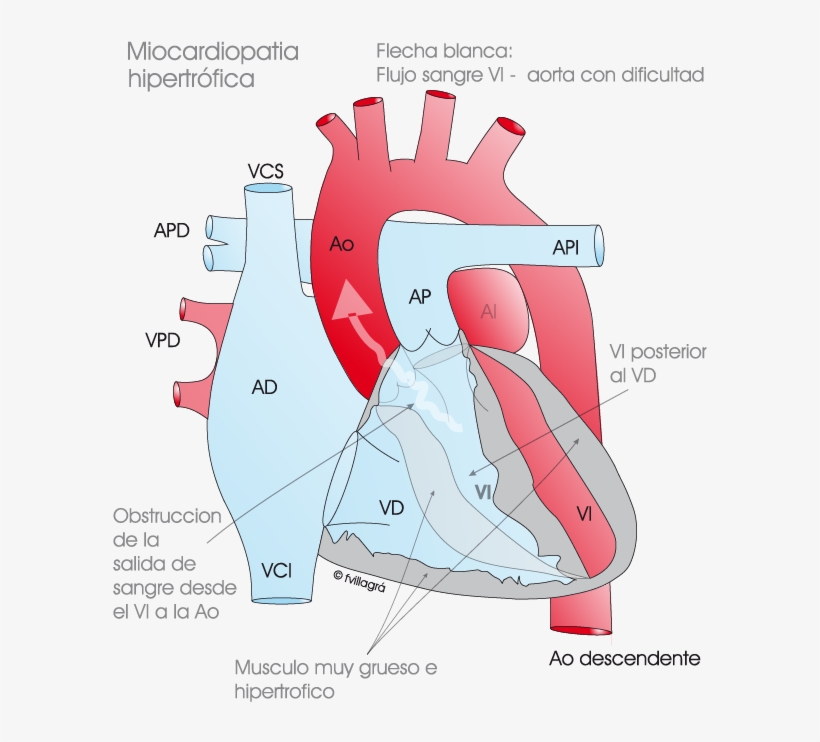 Miocardiopatía Hipertrófica - Mch Obstructiva, transparent png #3555975