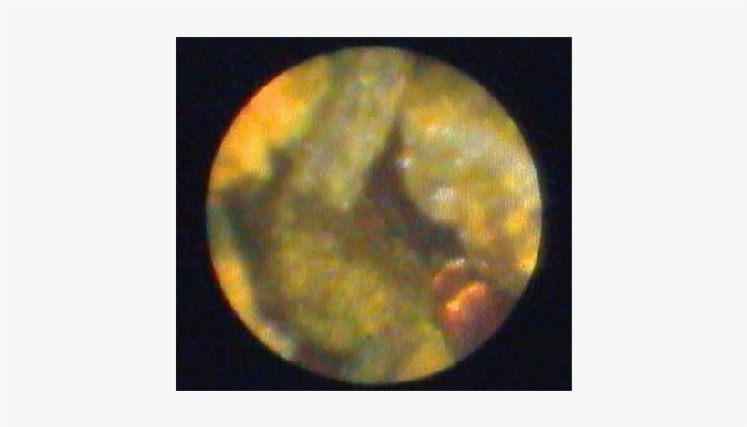 Spyglass™ Direct Visualization System - Earth, transparent png #3600297