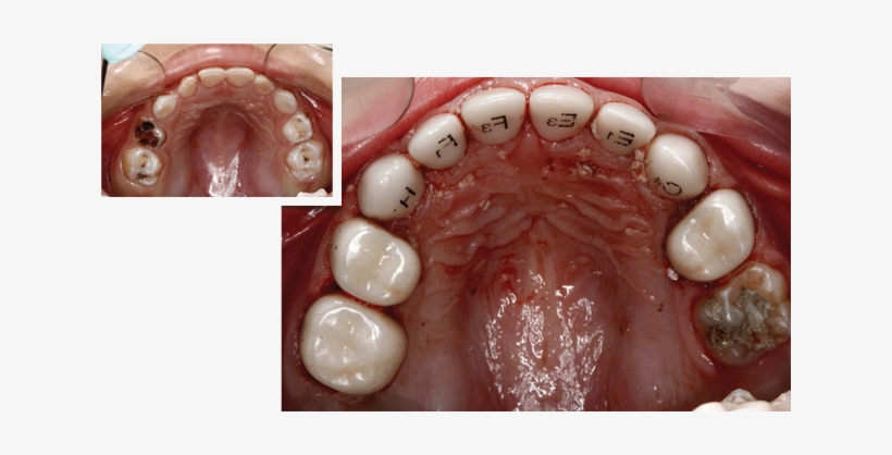 That Looks Natural, And Is Strong And Long Lasting - Ez Pedo Crown, transparent png #3600592