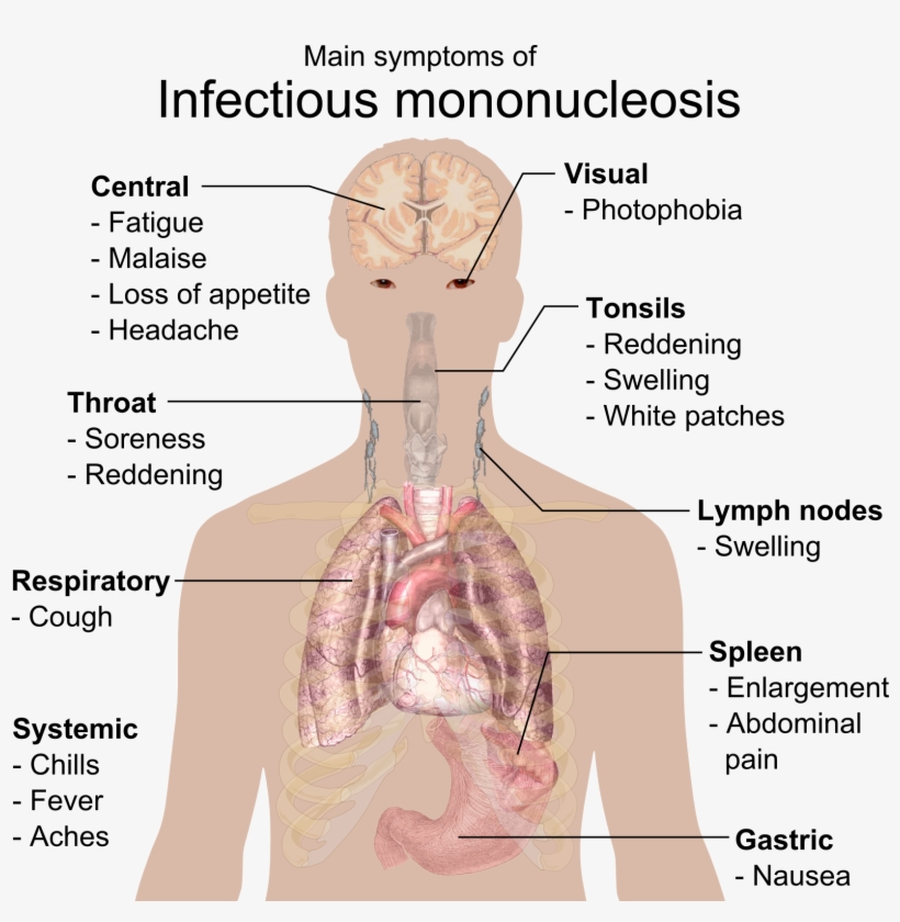 Main Symptoms Of Infectious Mononucleosis - Epstein Barr Virus, transparent png #3600960