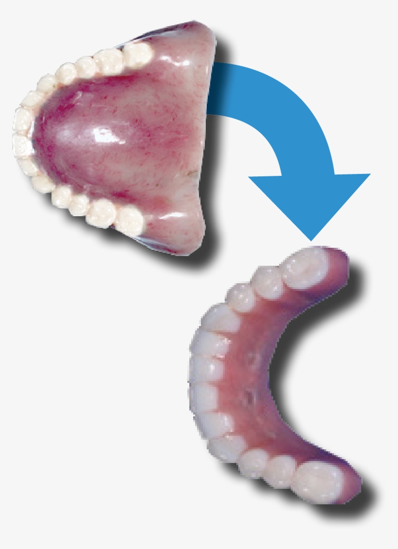 Implants There Is No Need For Thick, Long Flanges On - Insect, transparent png #3601257