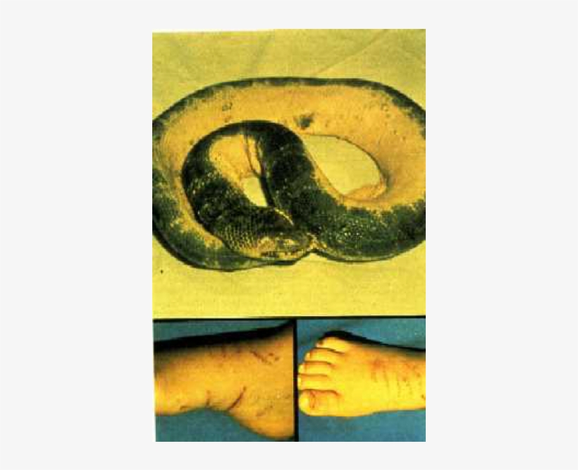 Photo Of Wounds Inflicted On The Victim And The Snake - Photograph, transparent png #3670780