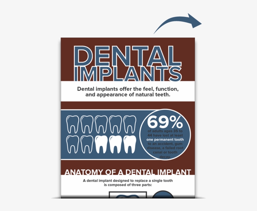 Dental Implants - Free Download - Infographic Implants, transparent png #3674307