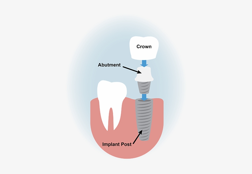 Dental Implants Graphic, transparent png #373160