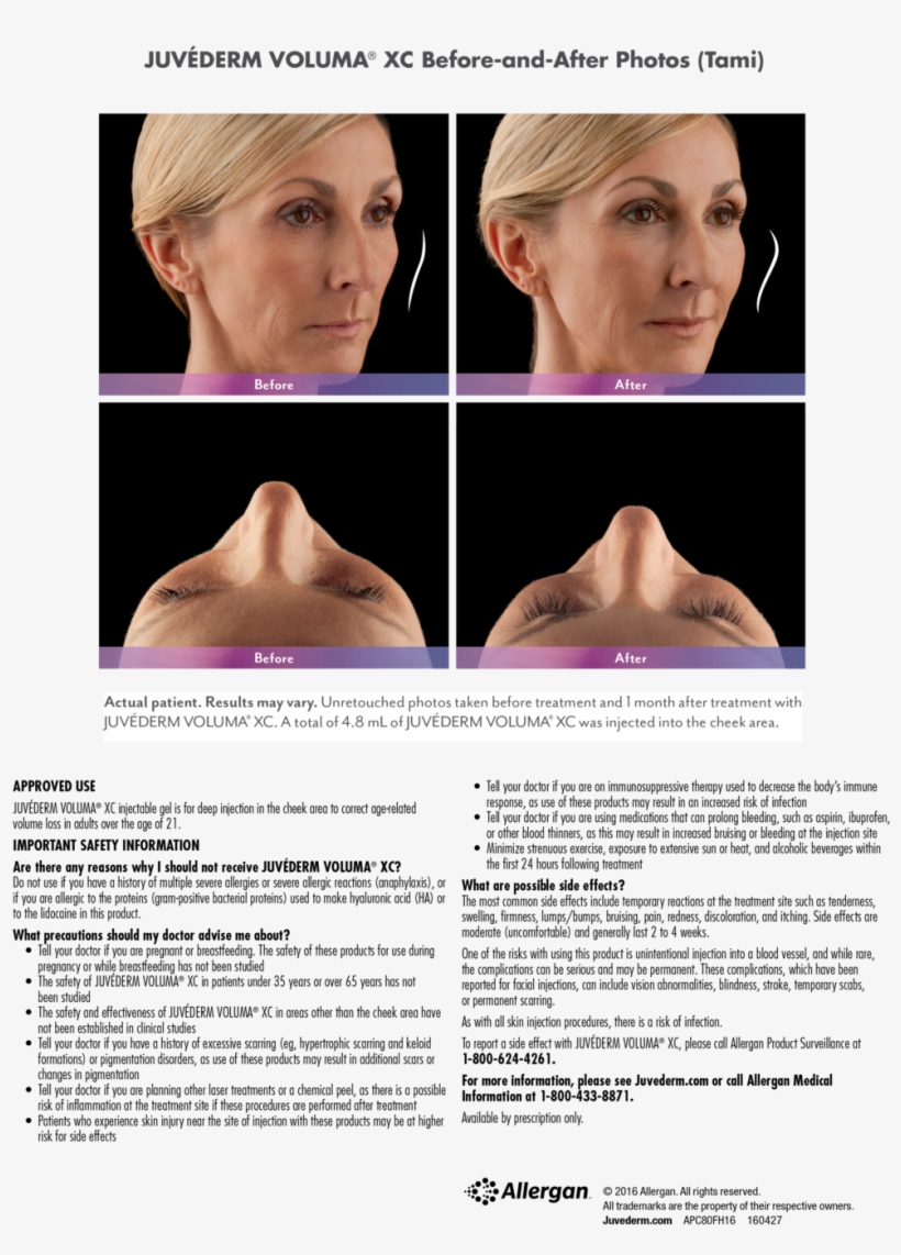 Tami Web-voluma - Injectable Filler, transparent png #3706034