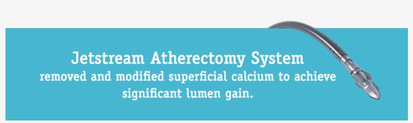 Case Example From Jetstream Calcium Study Distal Sfa/proximal - United Supermarkets, transparent png #3714809