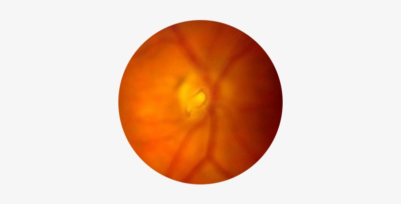 Flashes-floaters - Macular Degeneration, transparent png #3752869