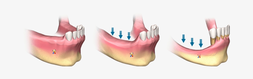 Beneficios De La Regeneración Y Creación De Hueso - Implantes Dentales Poco Hueso, transparent png #3770456