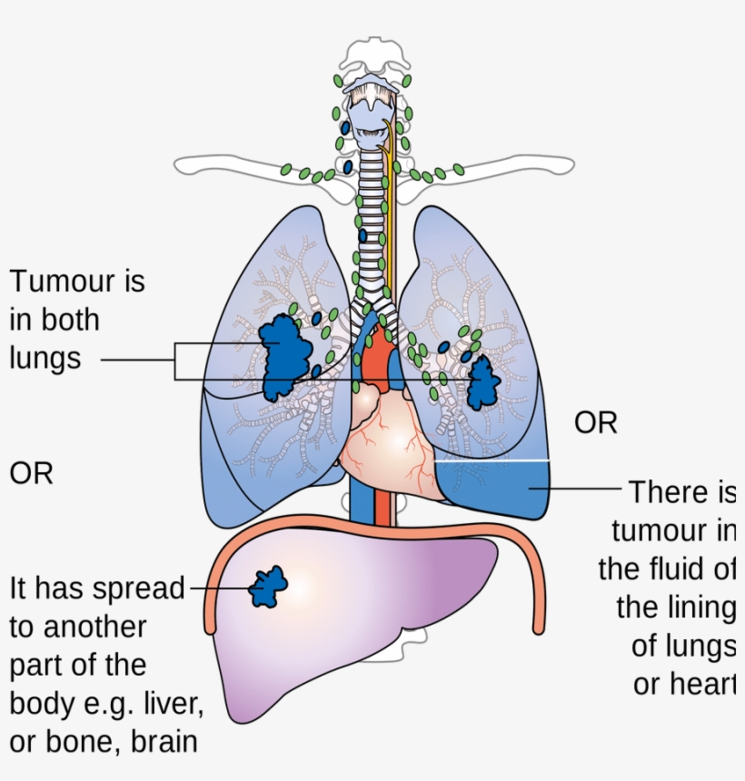 Negative Effects Of Smoking - Does Asbestos Affect The Lungs, transparent png #3778345