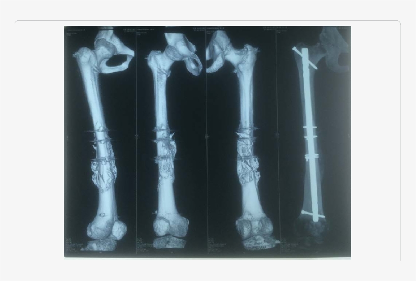 3d Ct Scan And X-ray Of Femur With Accelerated Union - Bone Fracture, transparent png #3797225