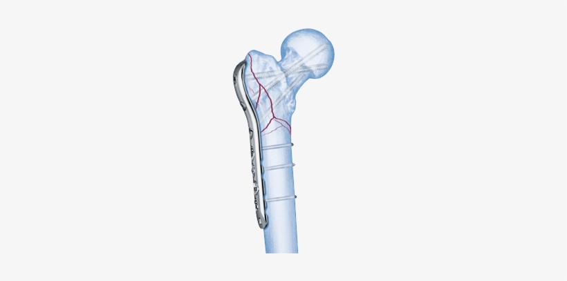 Choose - Femur Reverse Distal Lcp, transparent png #3797250