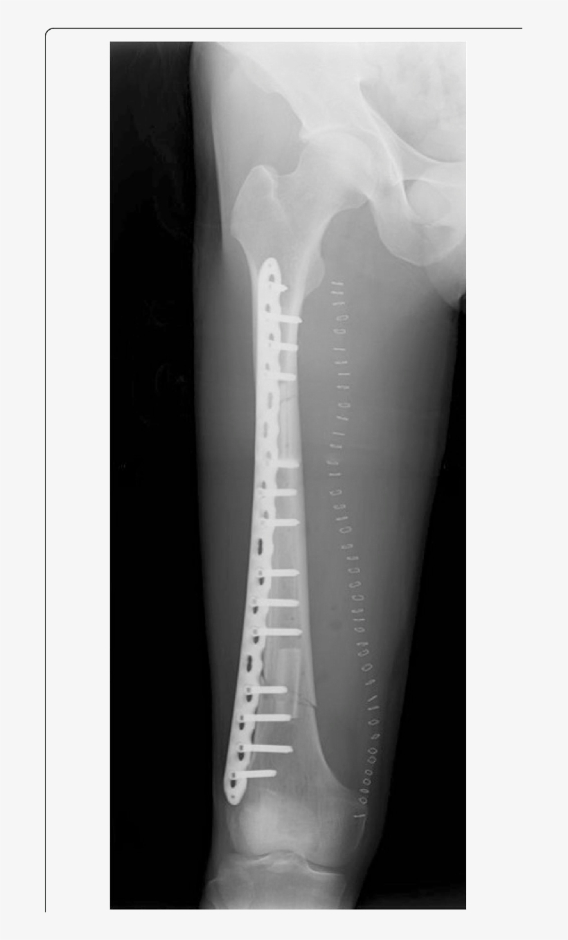 Postoperative Radiography After The Femur Reconstruction - X-ray, transparent png #3797405