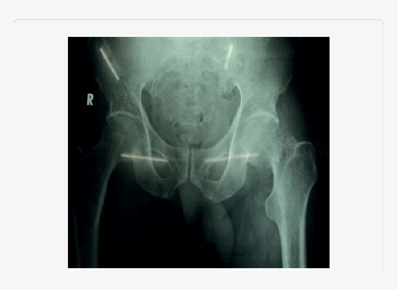 Showing The Trans-cervical Fracture Neck Of Femur Left - Orthopedic Surgery, transparent png #3797654