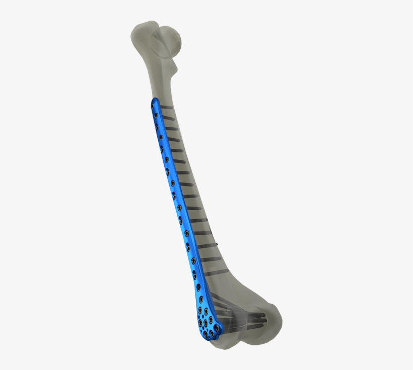 Distal Femur Locking Plate - Locking Plate Distal Femur, transparent png #3797672
