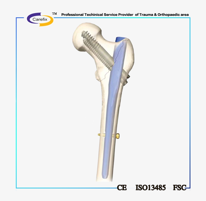 Carefix Femur And Tibia Interlocking Nail,metallic - Orthopaedic Femoral Surgery, transparent png #3797902