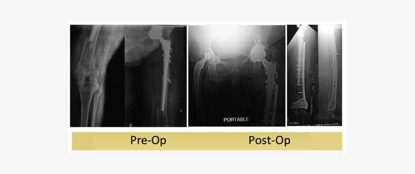 Left Periprosthetic Femur Fracture Operated By Dr Dshekhar - Radiology, transparent png #3798194