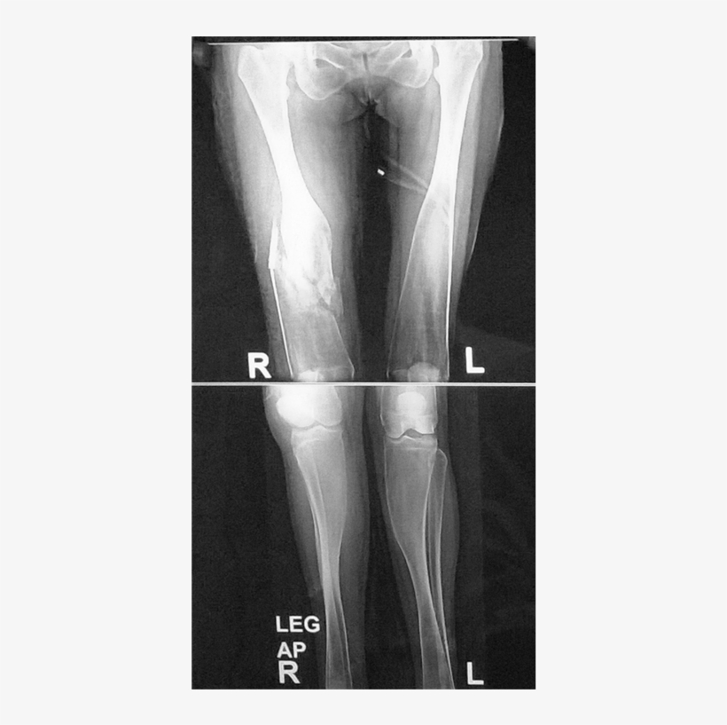 36 Years Old Female Patient Radiography Of Both Knee - X-ray, transparent png #3798295