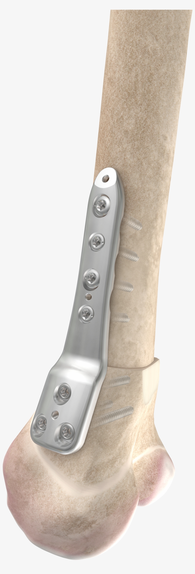 The Dfos System Includes Implants To Correct Several, transparent png #3798717