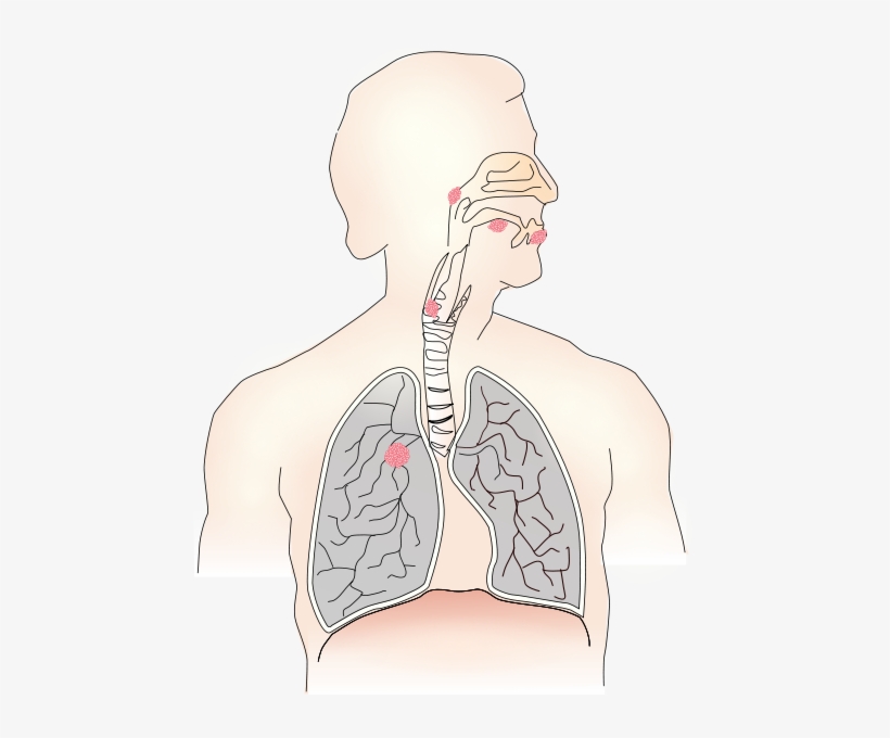 Cancer Caused By Smoking Png Images - Imagenes De Bradipnea, transparent png #3847585