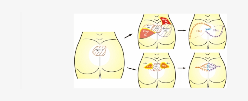 Schematic Diagram Of Couple-kissing Flap For The Treatment - Cartoon, transparent png #3854407