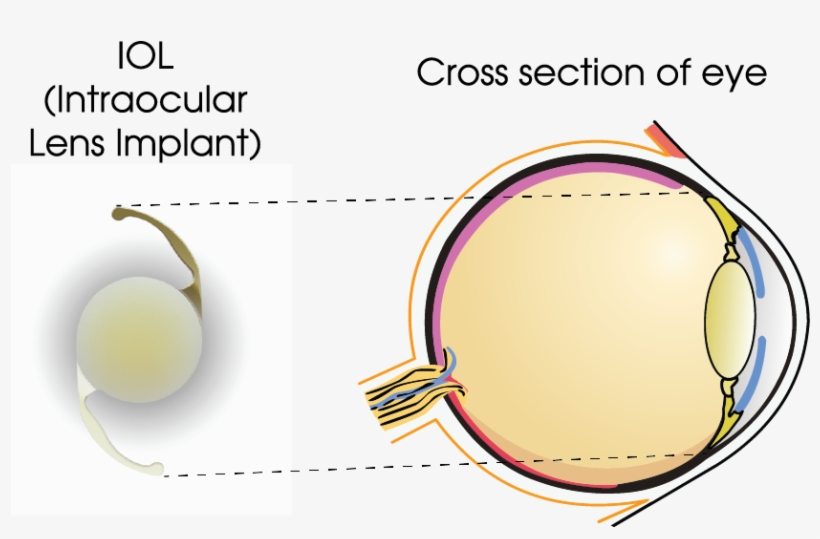 The Iol Acts As A Total Replacement For Your Natural - Portable Network Graphics, transparent png #3856461