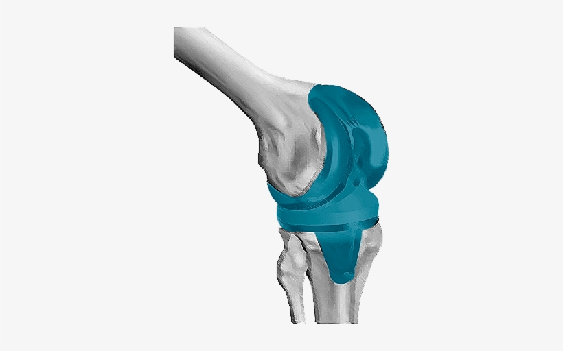 It Consists Of Removing The Damaged Cartilage And Bone - Germany, transparent png #3885152