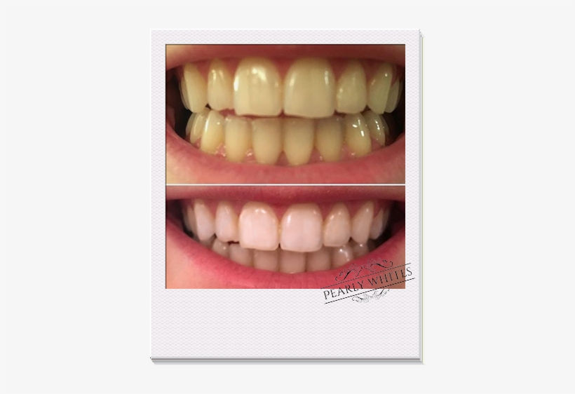 Pearly Whites Pro Kit Before And After Photo - Pearly Whites, transparent png #3889282
