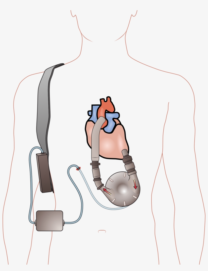 Aparato De Asistencia Ventricular, transparent png #3894090