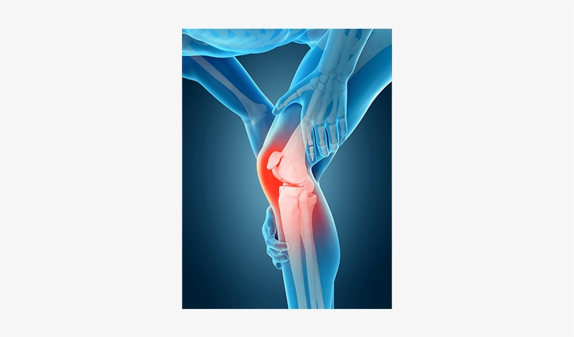 Knee Pain - Rodilla 3d, transparent png #3894989