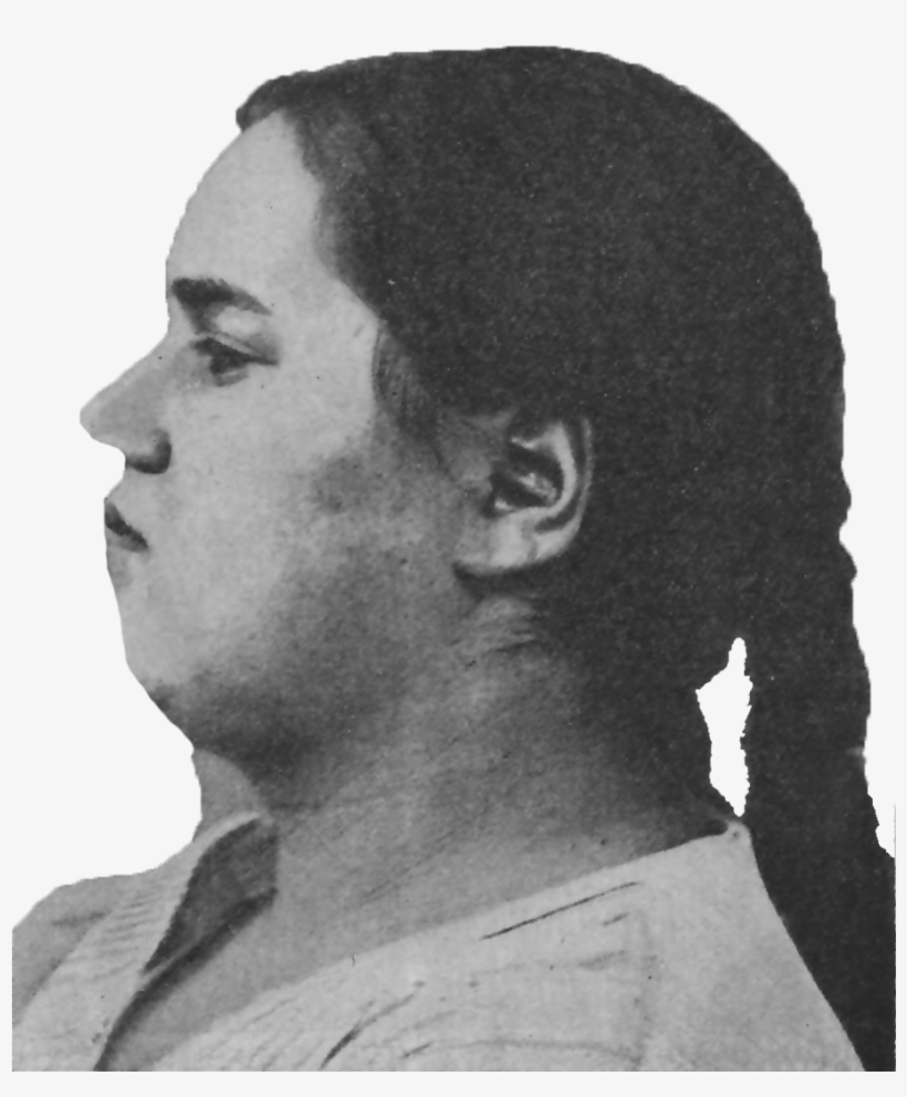 Schizophrenic Pubertial Weak-mindedness And Obesity, - Wikimedia Commons, transparent png #3919011