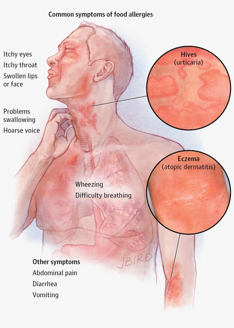 Allergy Download Transparent Png Image - Food Allergy Symptoms, transparent png #3919912