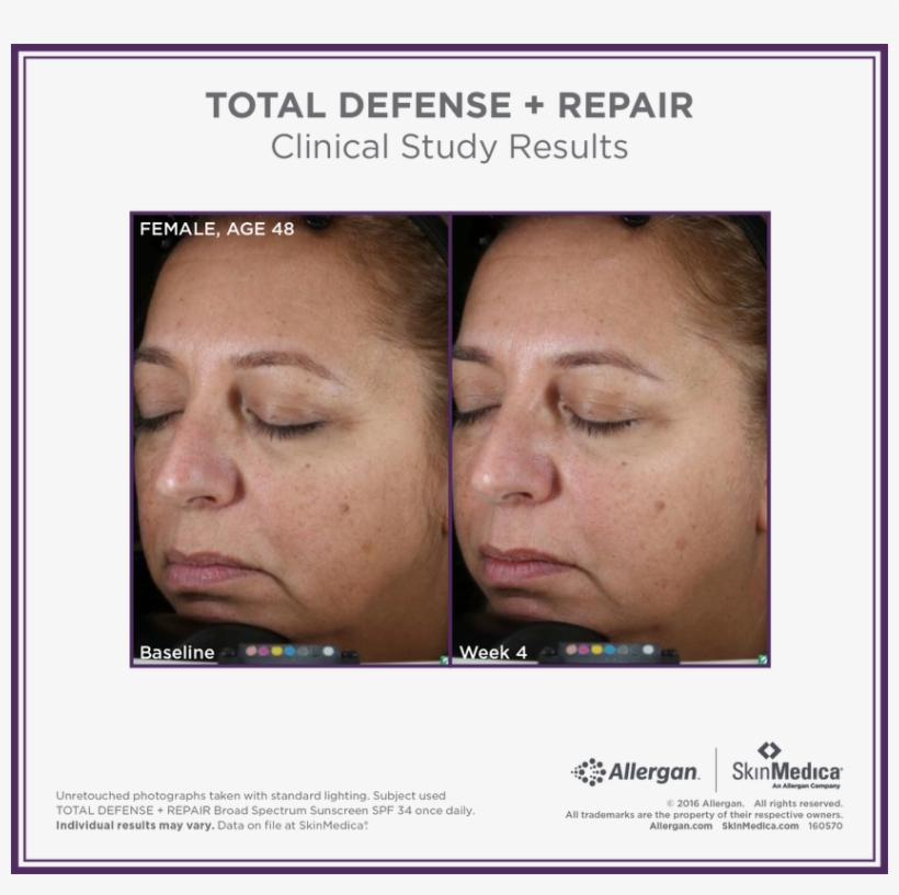 Tdr Before And After Gallery - Skinmedica H5 Before And After, transparent png #3928397