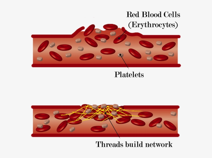 Blood Clot Formation Damage Of Blood Vessels Free Transparent PNG