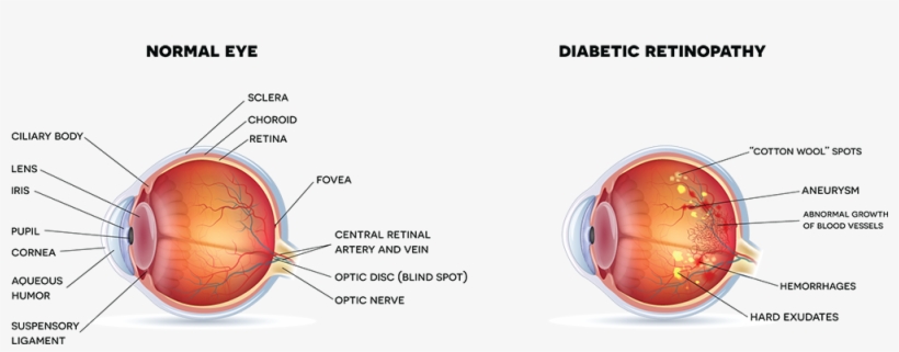 Posters Of Diabetic Retinopathy, transparent png #3937738