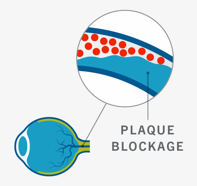 Veins In The Retina Become Blocked, Restricting Normal - Circle, transparent png #3954905