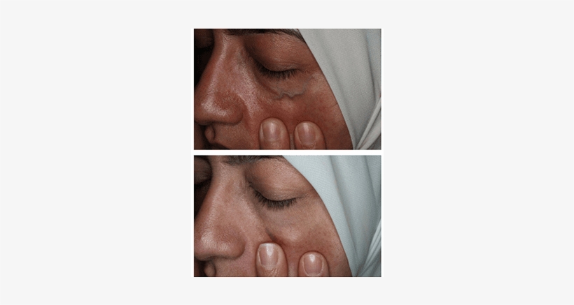 Facial Veins And Treatments - Sad, transparent png #3955013
