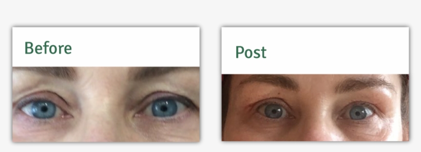 Risks Of Non-surgical Eye Lift Treatments - Close-up, transparent png #3955384