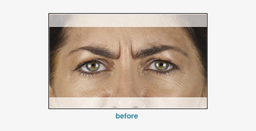 Injectable Filler, transparent png #3955588
