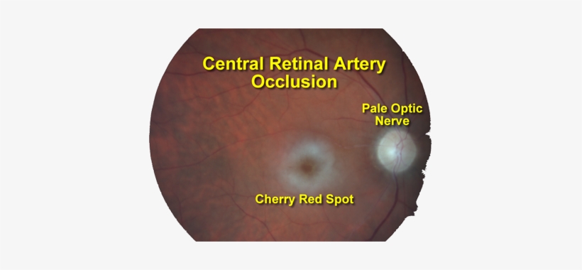 The Circulation To The Retina Enters The Eye Through - Occlusion Of Central Retinal Artery, transparent png #3955942
