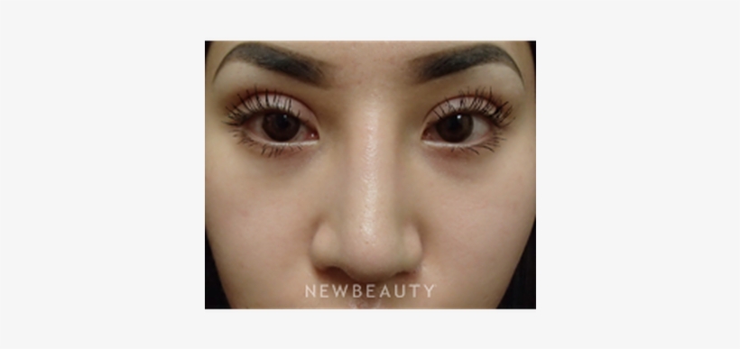 Dr Peter Chang Upper Blepharoplasty B - Blepharoplasty, transparent png #3958964