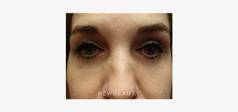 Dr Peter Chang Lower Blepharoplasty B - Blepharoplasty, transparent png #3959334