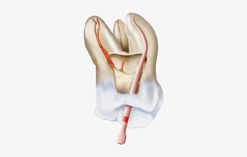 Conform Fit Gutta-percha Points - Carmine, transparent png #3967746