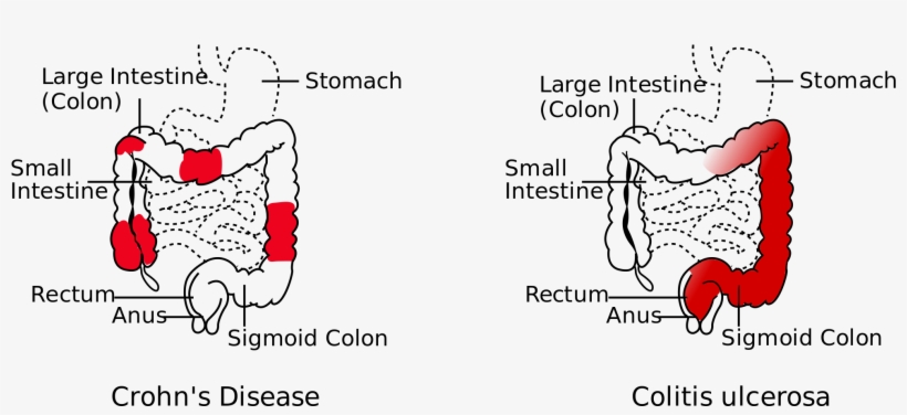 Open - Difference Between Crohns And Ulcerative Colitis, transparent png #3975635