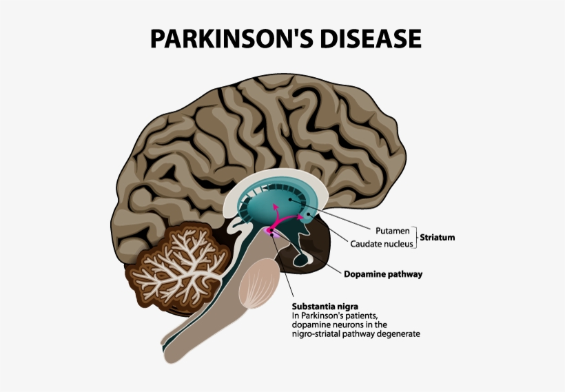 Parkinsons-pic - Parkinson's Disease Png, transparent png #3975658