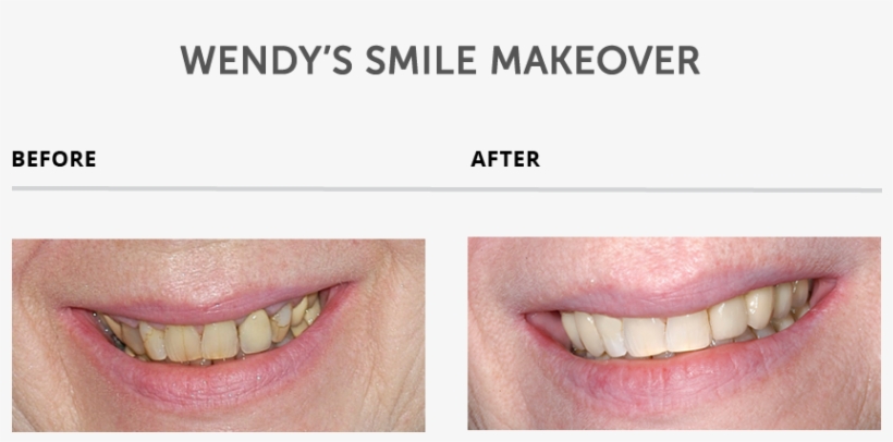 Weybridge Teeth Smile Makeover - Teeth Makeover, transparent png #3977867