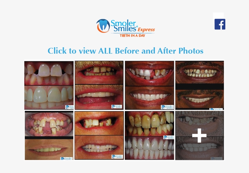 Express Teeth In A Day All On - Facebook, transparent png #3977888