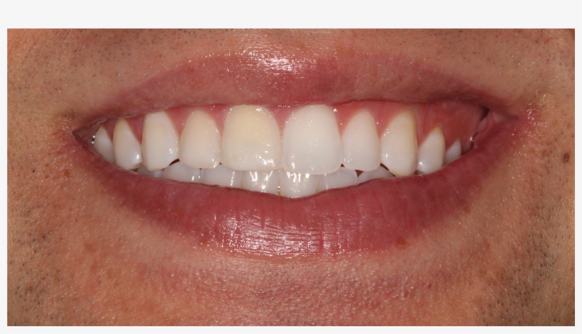 Partway - Tooth Bleaching, transparent png #3977934